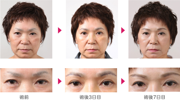 若返り11
